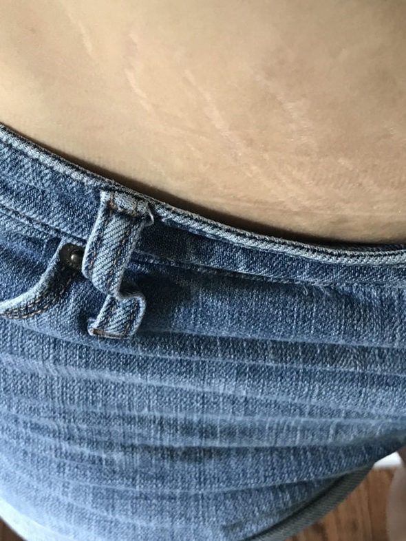 Kristen's belly stretch marks.