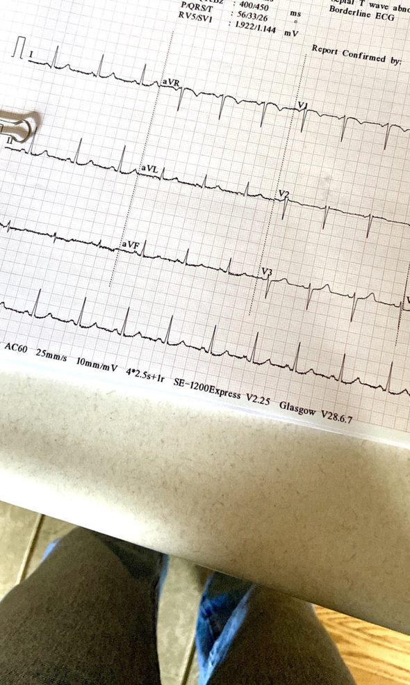 EKG strip.